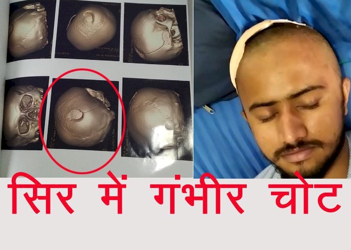 Jalore  के भागली सिंधलान गांव के युवक से मारपीट मामले में रिपोर्ट दी जानलेवा हमले की, पुलिस ने जानलेवा हमले की धारा ही नहीं लगाई