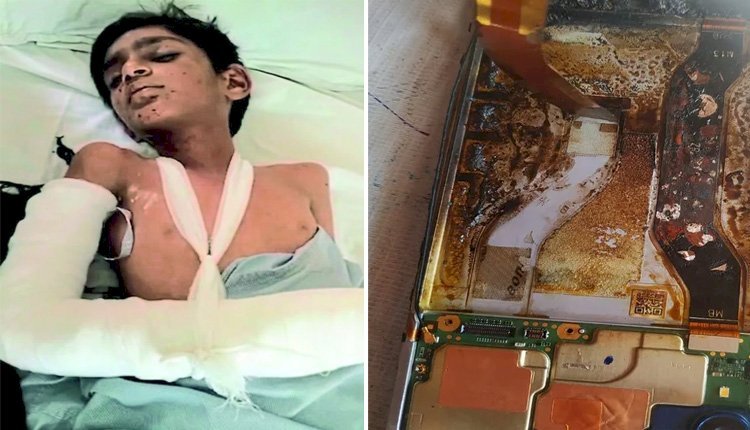 मोबाइल बैटरी में धमाके के साथ ब्लास्ट, ऑपरेशन कर काटनी पड़ी 5वीं कक्षा के बच्चे की हथेली